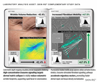 Exo Vitalise clinical results: sub-dermal matrix recoil and hollow volume restoration for GLP-1 sagging and Ozempic face — SKIN-RG

